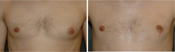 Male Breast Reduction Winter Park