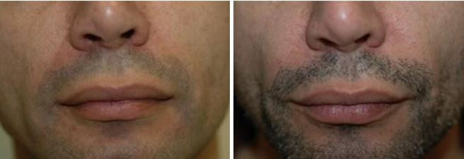 Dermal Fillers for Facial Enhancement Winter Park