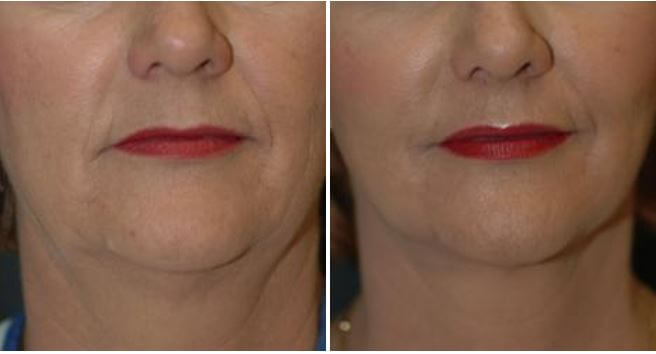 Neck Lift with Facelift Winter Park