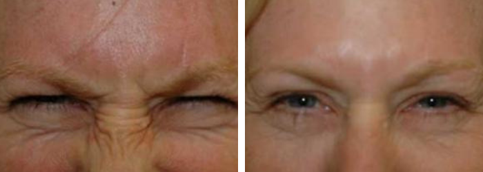 Botox Before & After Winter Park,