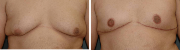 Male Breast Reduction Winter Park