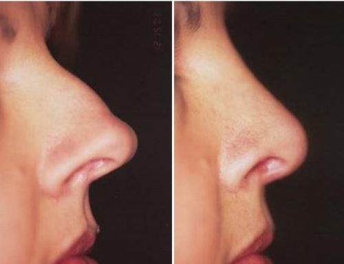 How Long is Recovery from a Rhinoplasty?