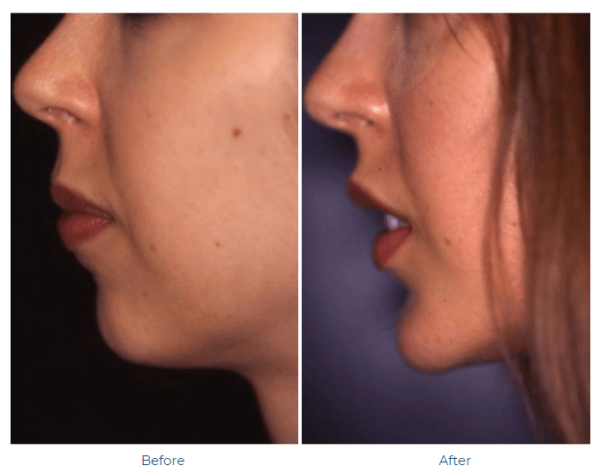 Chin Augmentation Before and After Winter Park