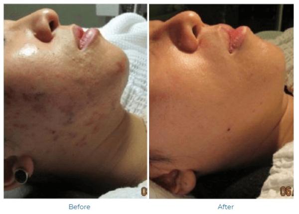 Acne Winter Park | Acne Scar Treatment | Winter Park Plastic Surgery & Laser Center