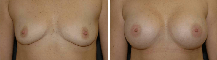 Breast Augmentation Winter Park, FL