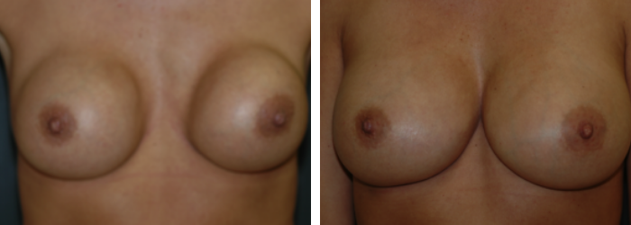 Breast Implant Revision Before & After Winter Park, Fl