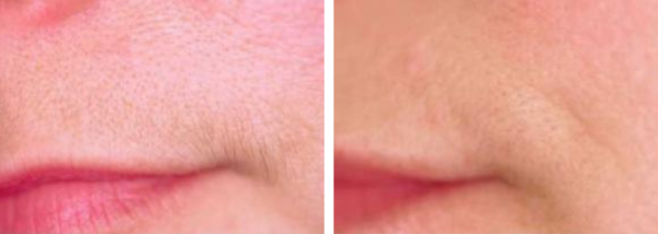 Laser Hair Removal Before & After Winter Park, Fl