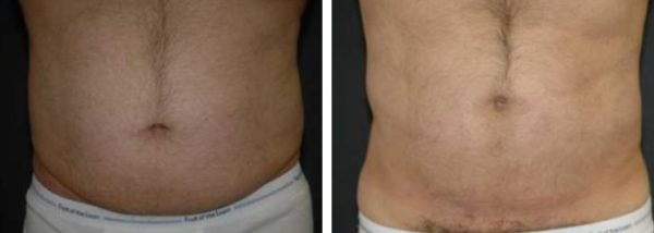 Male Liposuction Before & After Winter Park, FL