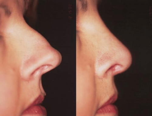 5 Tips to Your Best Rhinoplasty Recovery