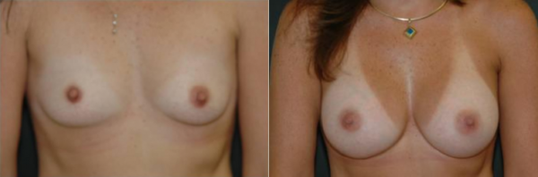 Winter Park Breast Augmentation