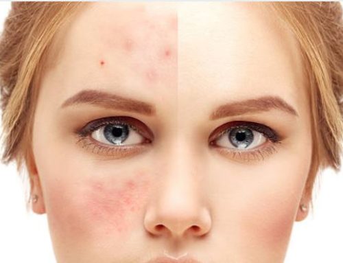 How Will Laser Treatments Help to Reduce Acne?